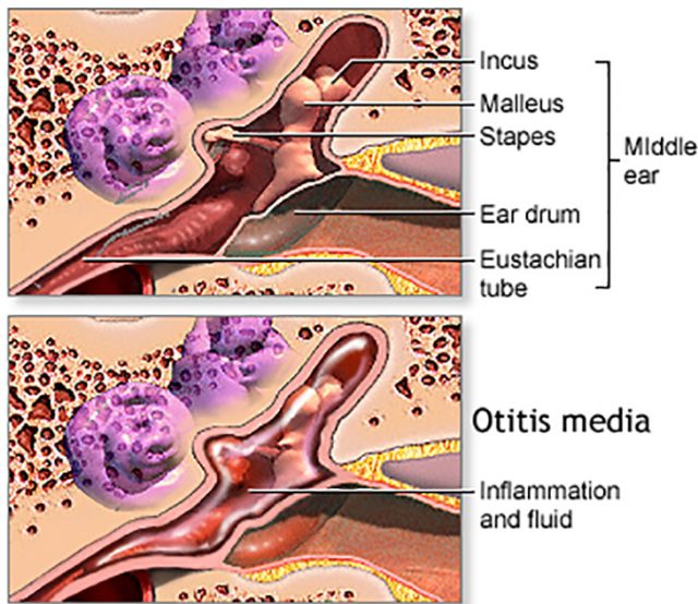 Ear infection? Antibiotics may not be the answer - Northwest Community ...